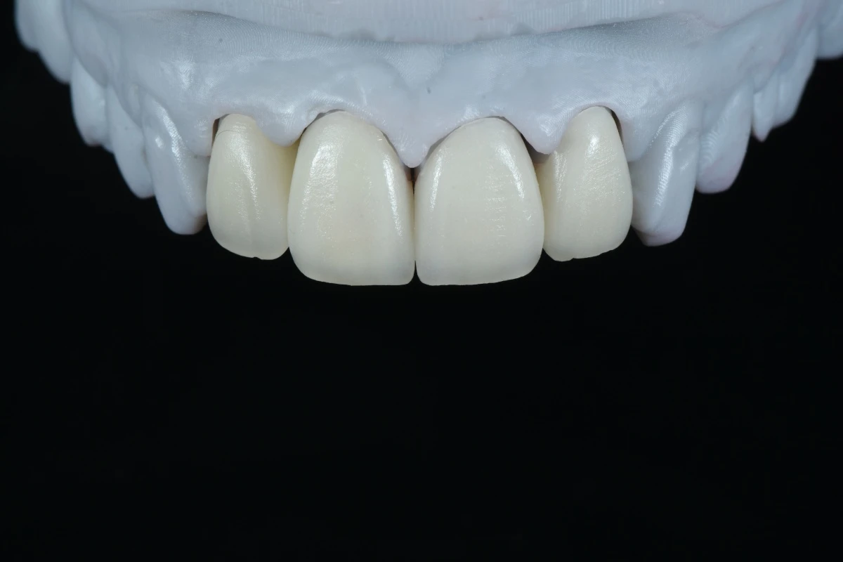 Four-Unit Maxillary Anterior E.max Layering Veneers Four-Unit Maxillary Anterior E.max Layering Veneers