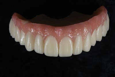 Privremena krunica od akrilne smole